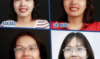 Chuyên gia điều trị những ca làm răng sứ hỏng – Cứu lấy nụ cười và niềm tin