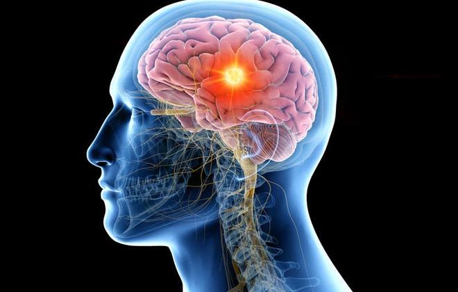 Đột phá: Xét nghiệm nước tiểu có thể phát hiện sớm khối u não