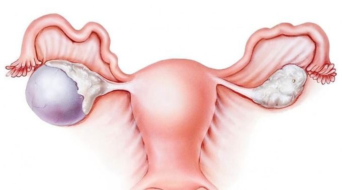 Phương pháp điều trị u nang buồng trứng hiện nay là gì?