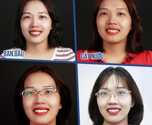 Chuyên gia điều trị những ca làm răng sứ hỏng – Cứu lấy nụ cười và niềm tin